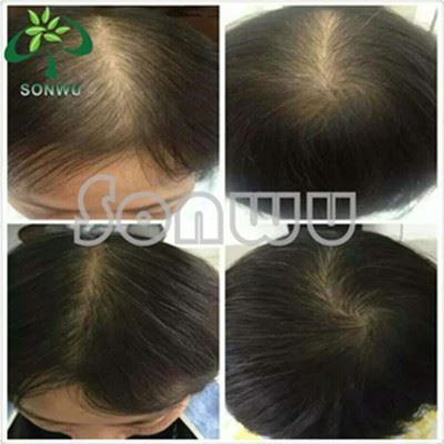 anti-hairloss