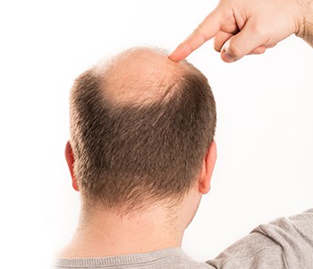 Menschen mit Haarausfall sind begeistert! Dieses Produkt kann Haarausfall tat...