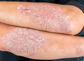 Psoriasis